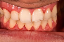Before